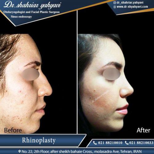جراحی بینی 399 (1)