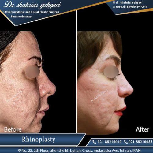 جراحی بینی 402 (1)