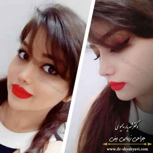 جراحی بینی 403