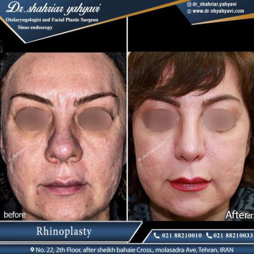 جراحی بینی 403 (1)