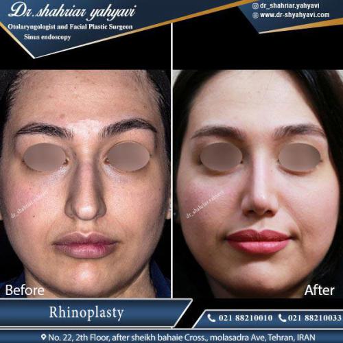 جراحی بینی 404 (1)