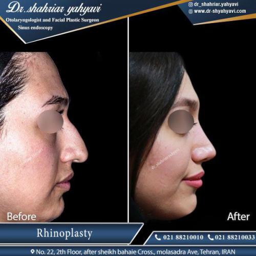جراحی بینی 405 (1)