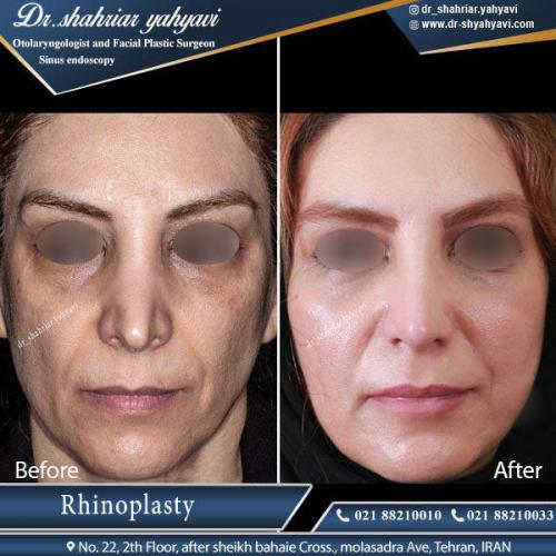 جراحی بینی 406 (1)