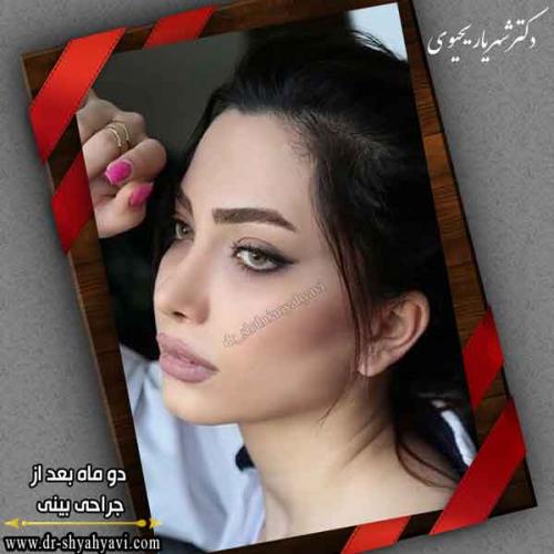 جراحی بینی 408