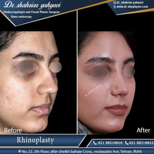 جراحی بینی 408 (1)