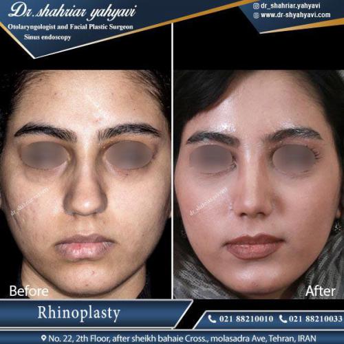 جراحی بینی 409 (1)