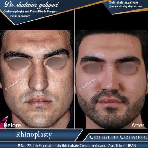 جراحی بینی 410 (1)