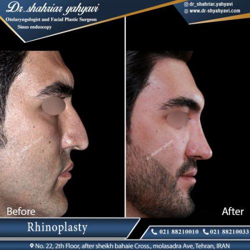جراحی بینی 411 (1)