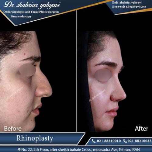 جراحی بینی 412 (1)