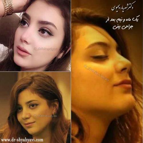 جراحی بینی 413