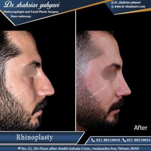 جراحی بینی 413 (1)