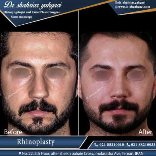 جراحی بینی 414 (1)