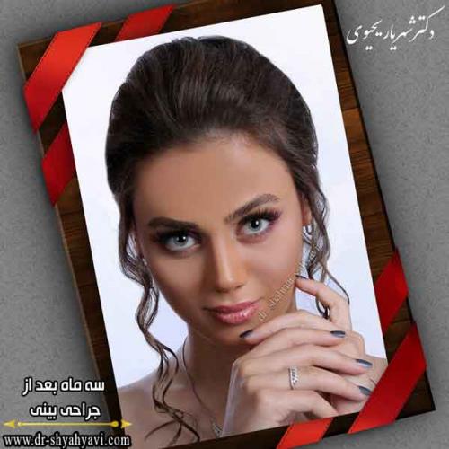 جراحی بینی 415