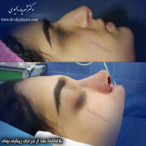 جراحی بینی 416