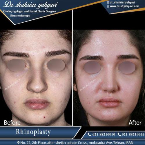 جراحی بینی 416 (1)