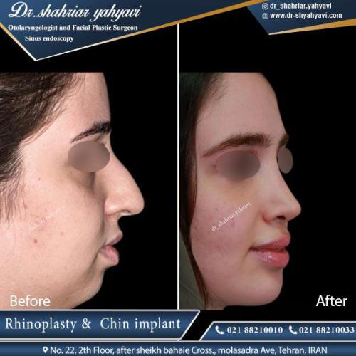 جراحی بینی 417 (1)