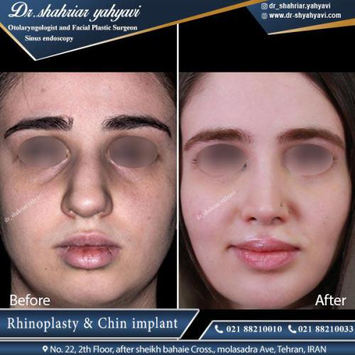 جراحی بینی 418 (1)