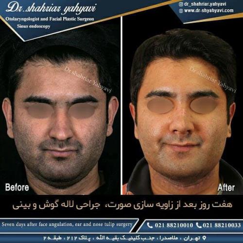 جراحی بینی 419 (1)