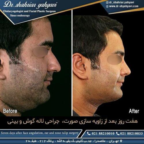 جراحی بینی 420 (1)