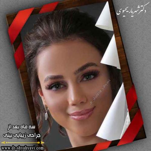 جراحی بینی 421