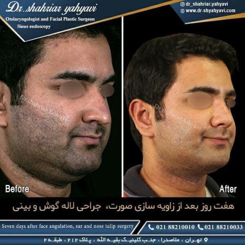 جراحی بینی 421 (1)