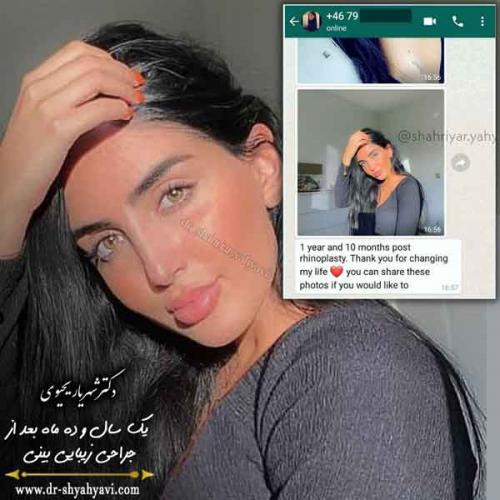 جراحی بینی 423