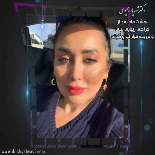 جراحی بینی 424