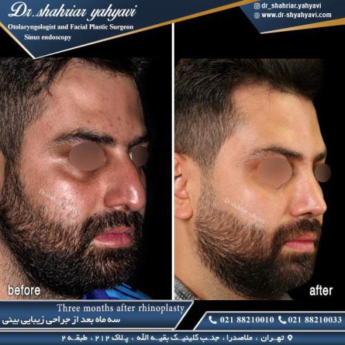 جراحی بینی 424 (1)