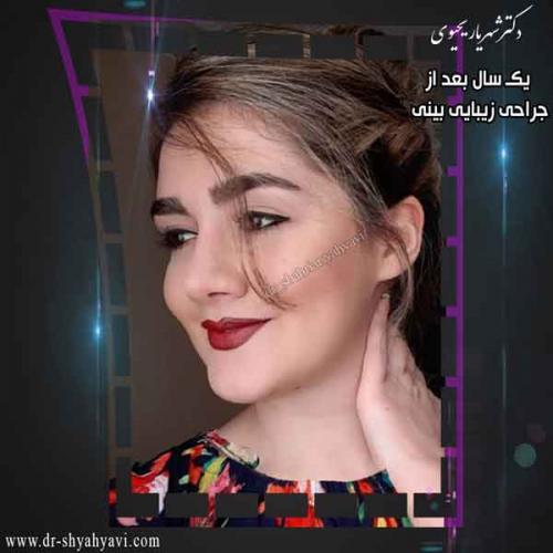 جراحی بینی 425