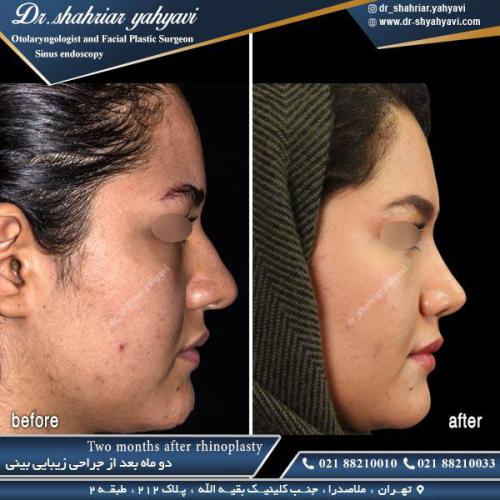 جراحی بینی 426 (1)