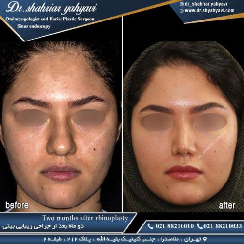 جراحی بینی 427 (1)