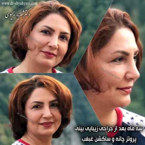 جراحی بینی 428