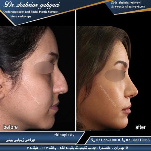 جراحی بینی 429 (1)