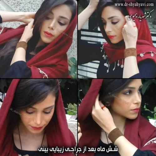 جراحی بینی 430