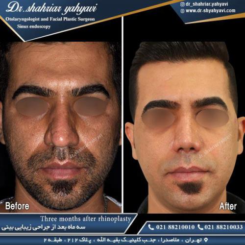 جراحی بینی 431 (1)