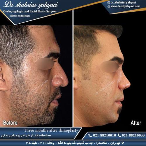 جراحی بینی 432