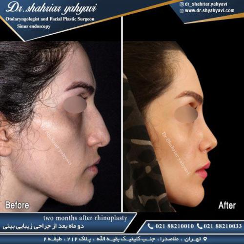 جراحی بینی 434
