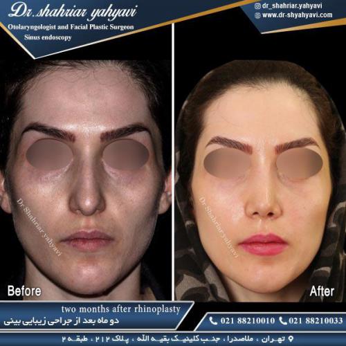 جراحی بینی 435