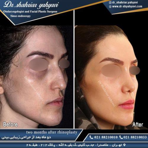 جراحی بینی 436