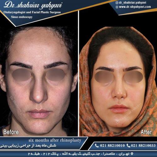 جراحی بینی 438