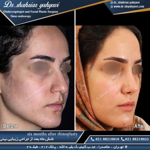 جراحی بینی 439