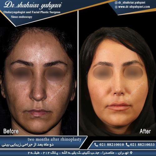 جراحی بینی 440