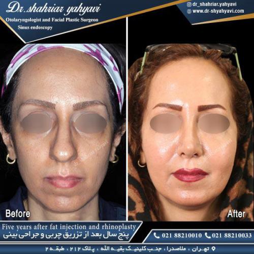 جراحی بینی 443