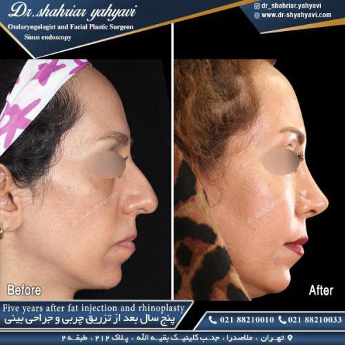 جراحی بینی 444