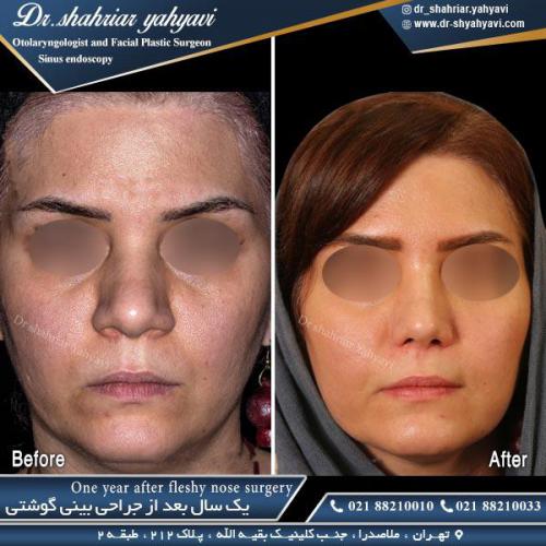 جراحی بینی 445
