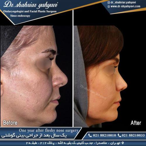 جراحی بینی 446