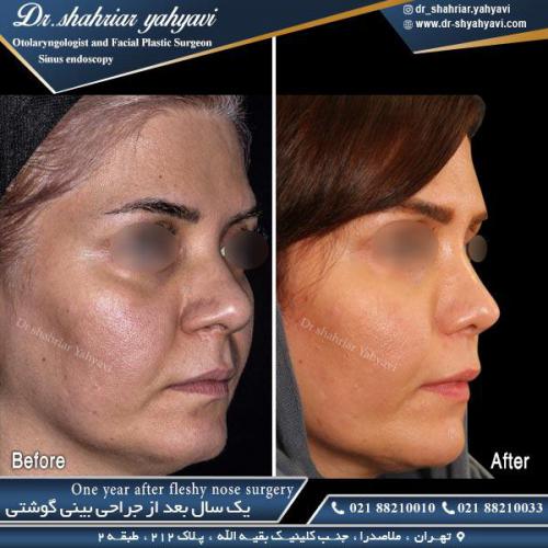 جراحی بینی 447