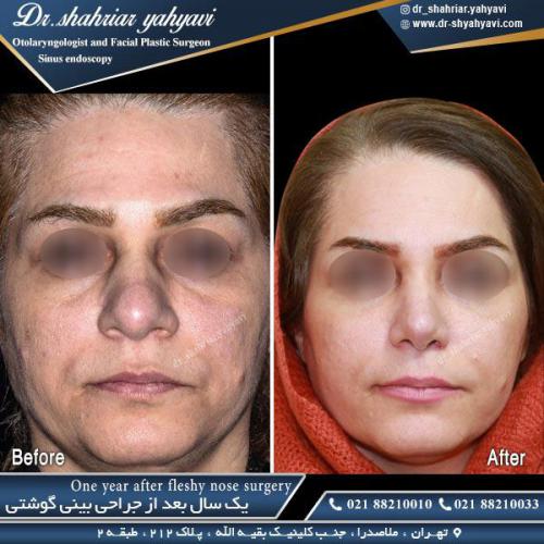 جراحی بینی 448