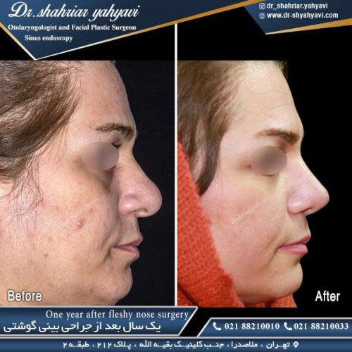 جراحی بینی 449