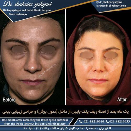 جراحی بینی 450